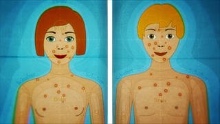 Animiert -  Ein Junge und ein Mädchen mit Pickeln im Gesicht und am Oberkörper. 